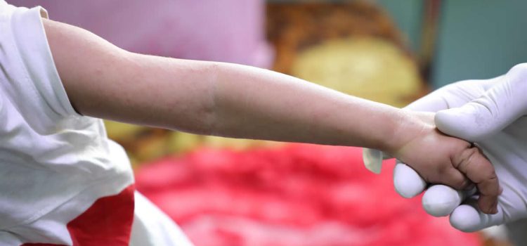 Realizan vigilancia epidemiológica por caso sospechoso de sarampión Realizan vigilancia epidemiológica por caso sospechoso de sarampión