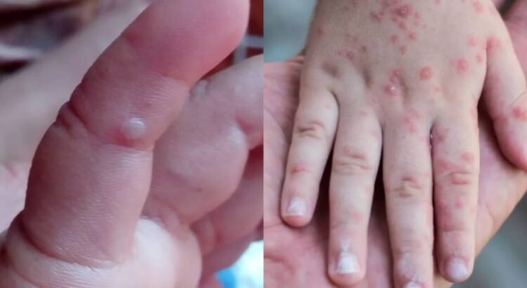 Se incrementan a 130 los casos de contagios del virus coxsackie en Zacatecas