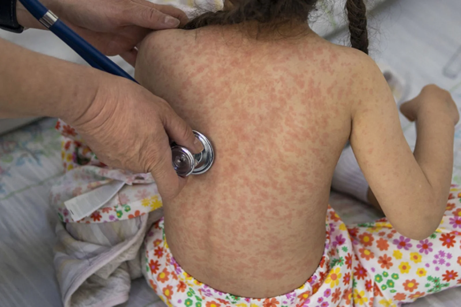 Zacatecas, entre los estados con más fallecimientos por sarampión